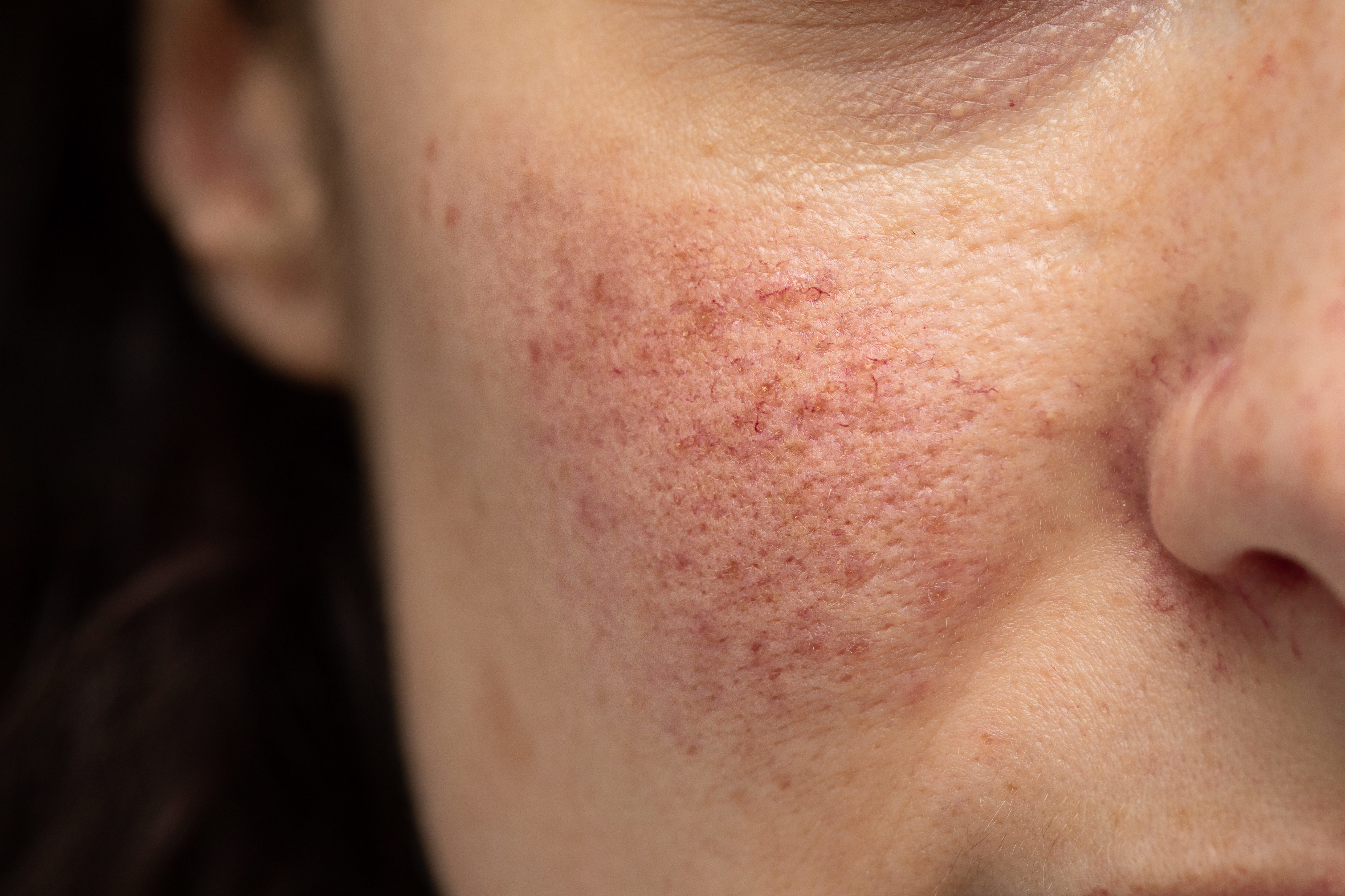 Rosacea-Prone Skin