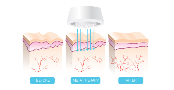 Metatherapy