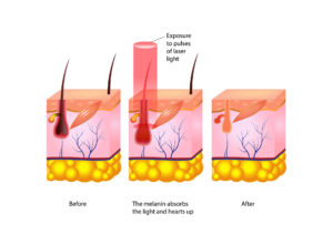 How does laser hair on sale removal work